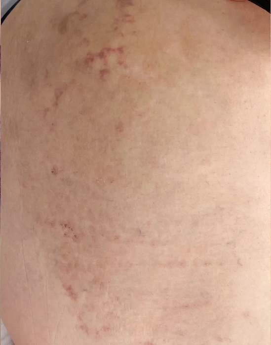 Treatment of skin defects VBEAM