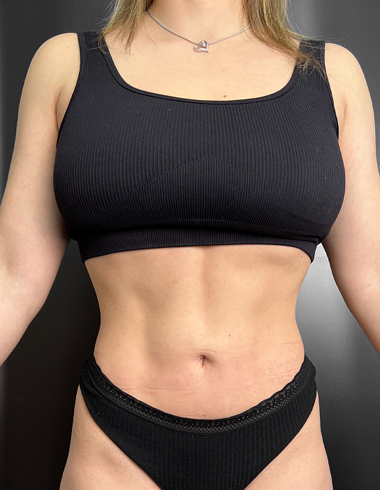 Liposculpture