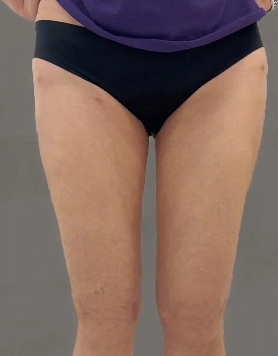 Thigh liposuction